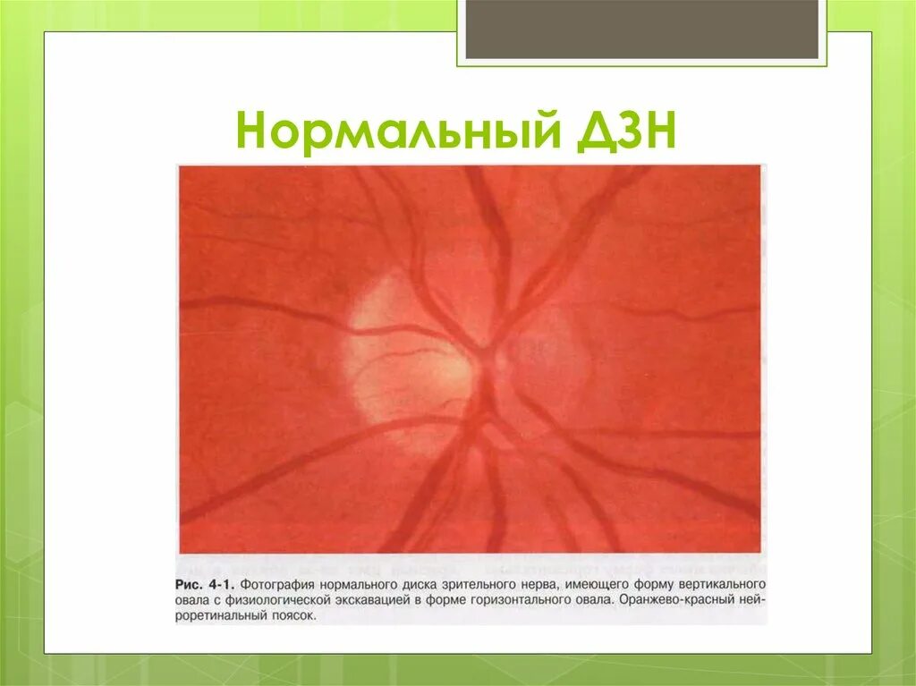 Норма зрительного нерва. Гипоплазия диска зрительного нерва. Экскавация диска зрительного нерва при глаукоме 1 стадии.