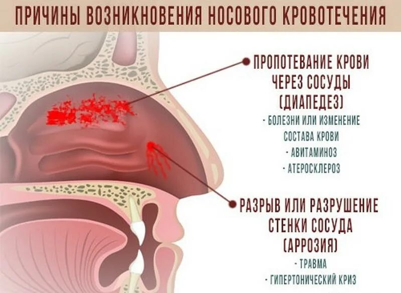 Носовые кровотечения клинические рекомендации