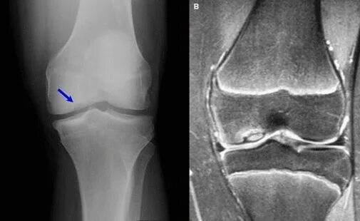 Два мыщелка. Остеохондропатия Кенига. Болезнь Кенига коленного сустава. Рассекающий остеохондрит надколенника рентген. Остеохондропатия бедренной кости Кенига.