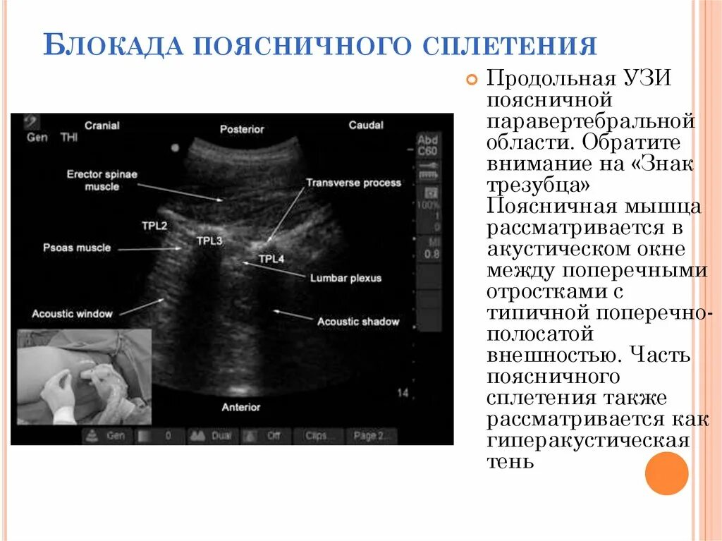 Паравертебральная поясничная блокада. Паравертебральные блокады поясничного отдела. Блокада плечевого сплетения УЗИ. Акустическое окно в УЗИ это. Блокада пояснично крестцового сплетения.