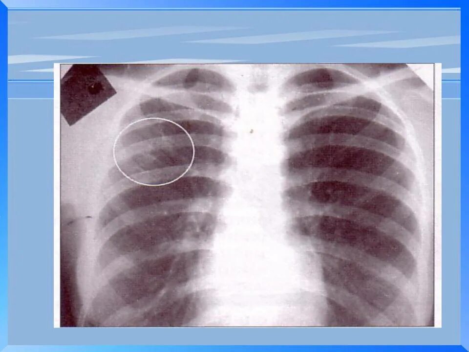 Рентген легких туберкулез снимки. Туберкулёз лёгких на рентгене. Как выглядит туберкулез на рентгеновских. Инфильтративный туберкулез флг. Рентгенография грудной клетки туберкулез.