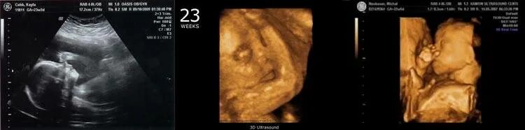 23 Недели беременности фото плода на УЗИ. УЗИ 22 недели беременности двойня. УЗИ беременности 22-23 недели.