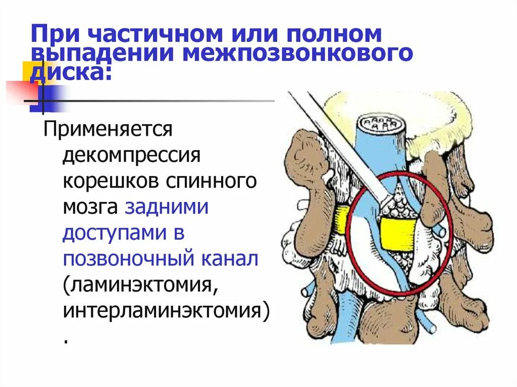 Спинальная нестабильность что это. Декомпрессия Корешков спинного мозга операция. Задняя декомпрессия Корешков спинного мозга. Декомпрессия Корешков позвоночника. Интерламинарная декомпрессия Корешков спинного мозга.