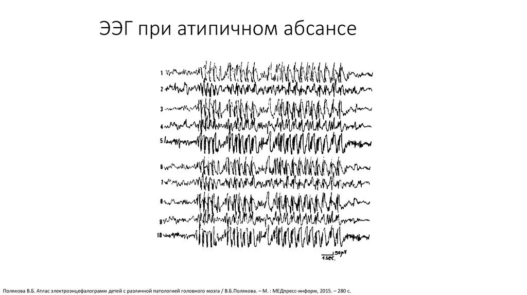 Детская абсансная эпилепсия. Атипичные абсансы на ЭЭГ. Абсансная эпилепсия на ЭЭГ. Детская абсансная эпилепсия на ЭЭГ. Паттерн абсанса на ЭЭГ.