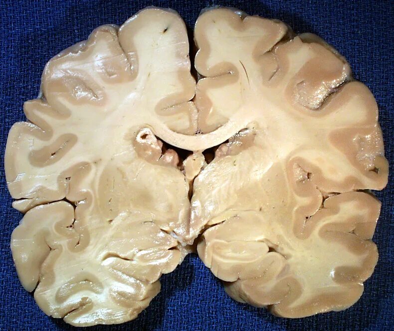 Склероз мозга. Гидроцефалия головного мозга макропрепарат. Макропрепарат туберозный глиоз. Рассеянный склероз патанатомия. Туберозный склероз головного мозга.