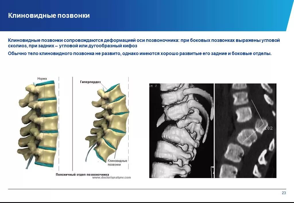 Изменение формы позвоночника. Клиновидная деформация тела позвонка кт. Клиновидная деформация тела th7 позвонка. Вид позвоночника сбоку при сколиозе. Клиновидная деформация l1 1ст.