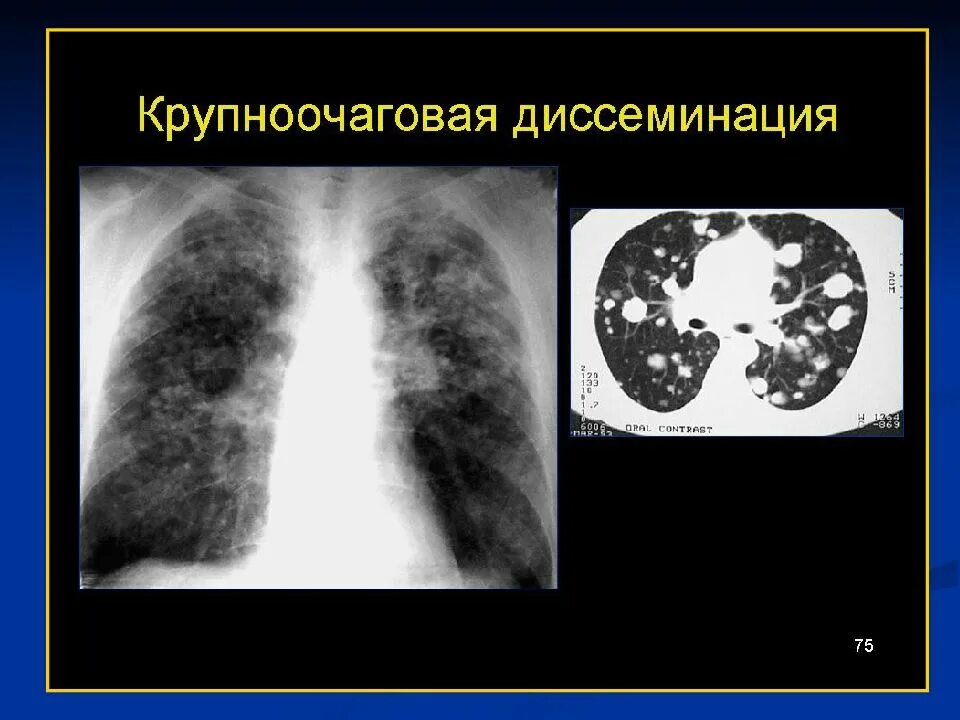 Очаговое поражение легких. Крупноочаговый диссеминированный туберкулез рентген. Диссеминированный туберкулез на кт. Диссеминированный туберкулёз лёгких рентген. Гематогенно диссеминированный туберкулез рентген.