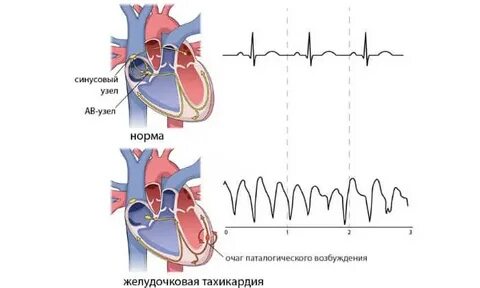 Как успокоить сердцебиение