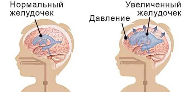 Внутричерепное давление головного мозга. Внутричерепное давление. Высокое черепное давление. Внутричерепная гипертензия у новорожденного. Черепное давление симптомы у детей.