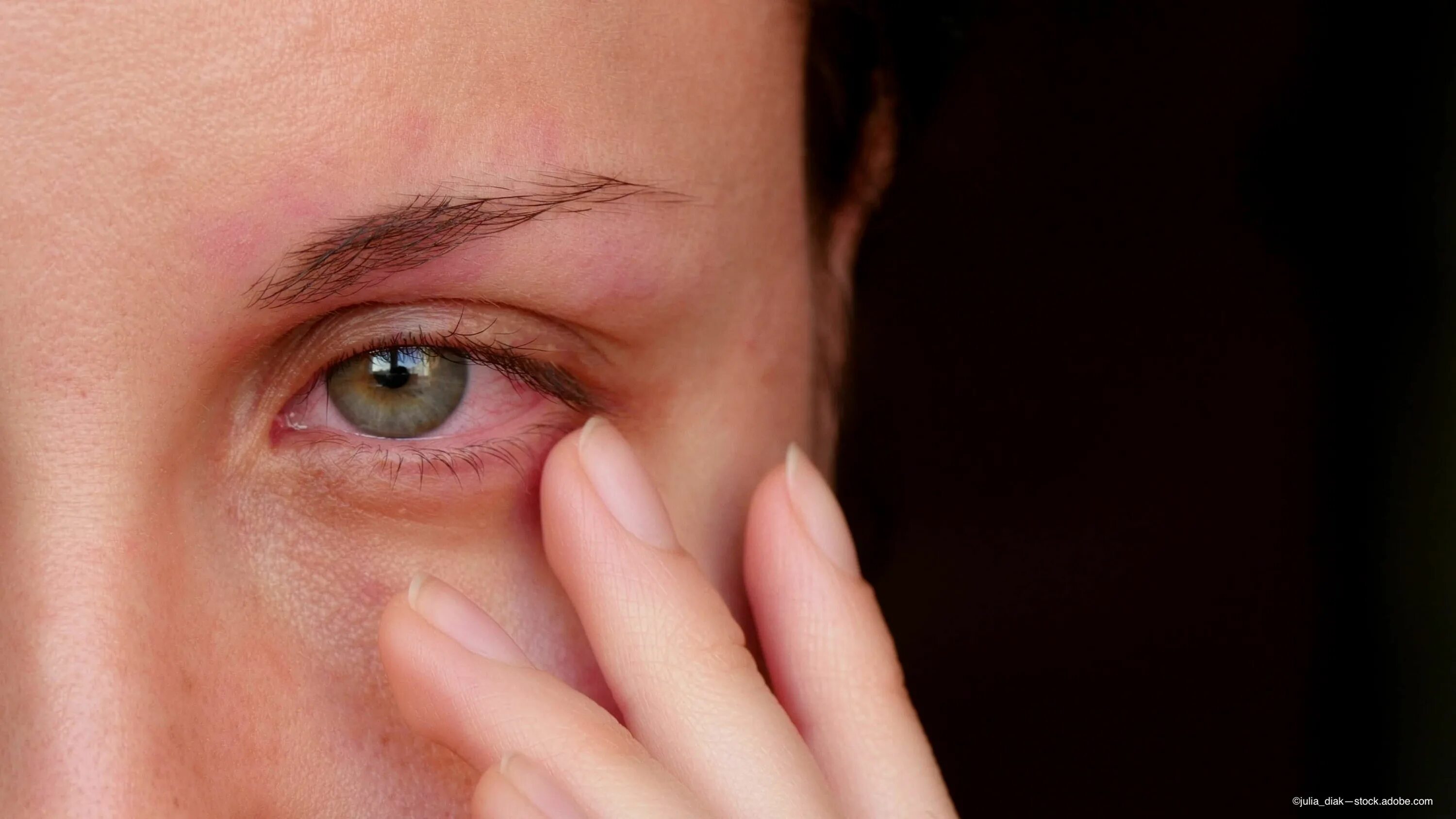 Лечение слезотечения глаз у взрослых. Красные глаза от усталости.