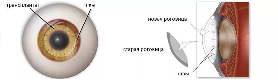 Сквозная кератопластика ход операции. Сколько восстанавливается роговица. Сколько восстанавливается роговица. Сколько восстанавливается роговица. Строение роговицы оболочки глаза.