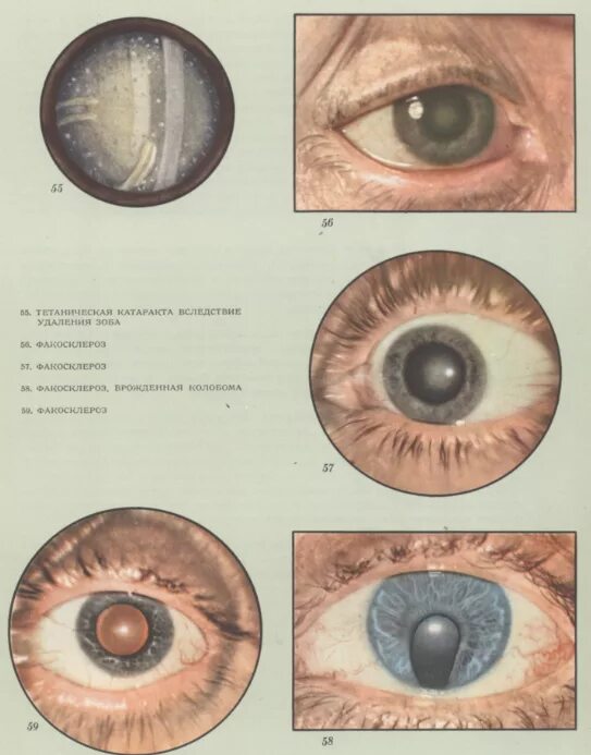 Начальная старческая катаракта. Сенильная катаракта глаза. Морганиевая катаракта. Старческая(сенильная)катаракта.