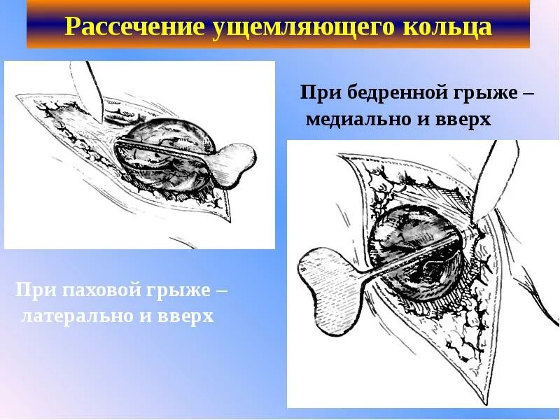 Ущемленная бедренная грыжа. Ущемление бедренной грыжи устраняют рассечением. Осложнения грыж презентация. Рассечение ущемляющего кольца при парафимозе. Частота ущемления бедренной грыжи.