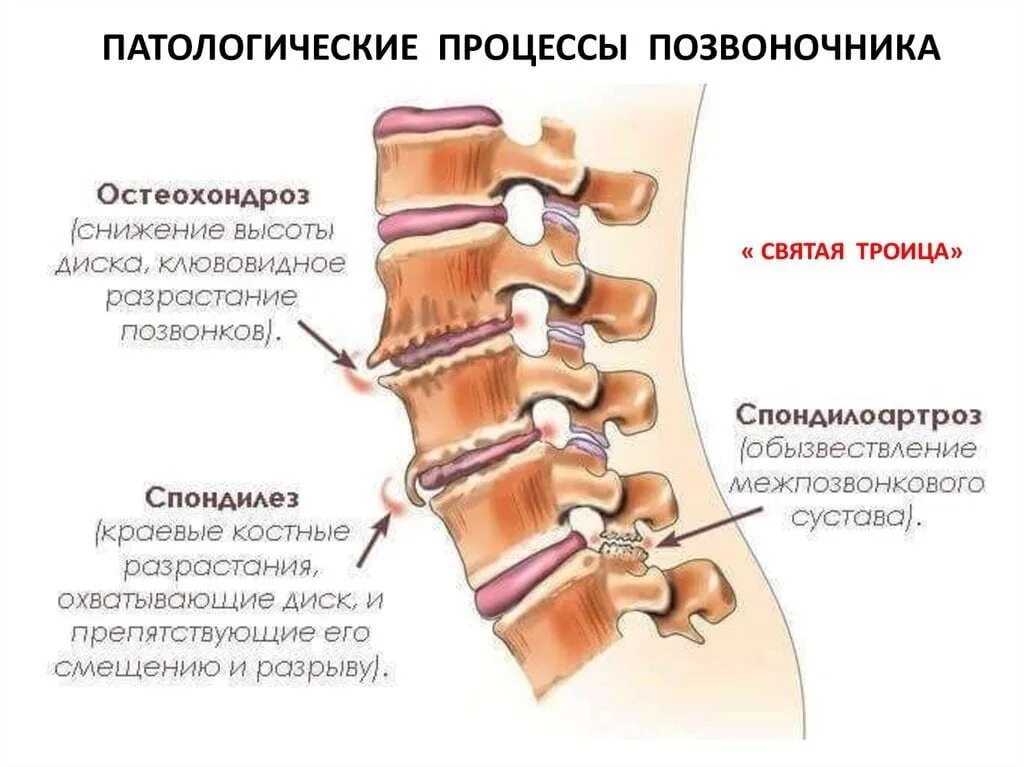 Остеохондроз поясничного отдела l5 s1. Деформирующий спондилез спондилоартроз поясничного отдела. Спондилоартроз c6 th1. Спондилёз поясничного отдела позвоночника что это такое. Диск позвоночника деформирующий спондилез.