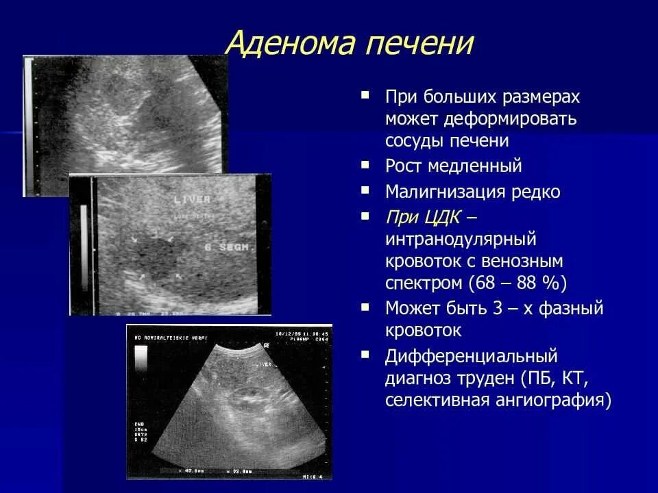 Доброкачественное образование печени. Аденома печени УЗИ картина. Гепатоцеллюлярная аденома мрт. Гепатоцеллюлярная аденома УЗИ. Образования печени на УЗИ.