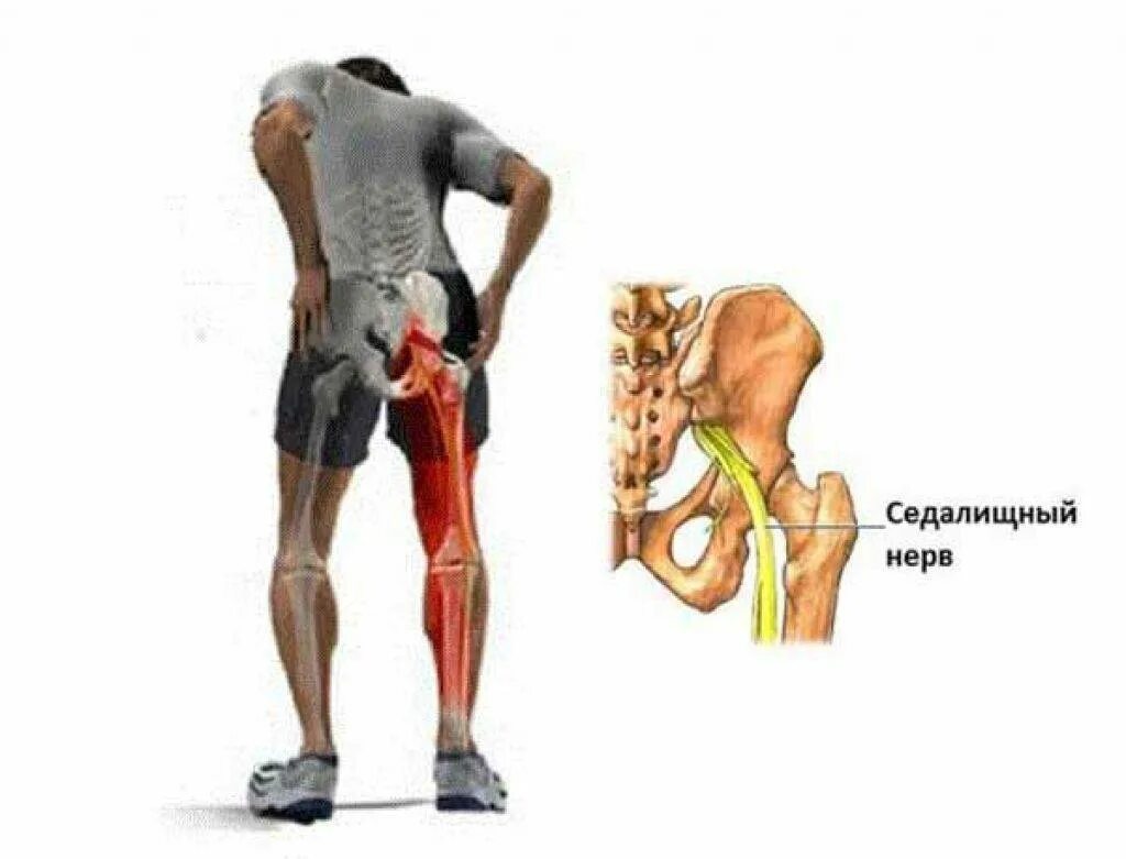 Воспаление седалищного нерва симптомы у мужчин. При защемлении седалищного нерва. Защемило седалищный нерв. Защемление седалищного нерва. Ишиас седалищного нерва симптомы.