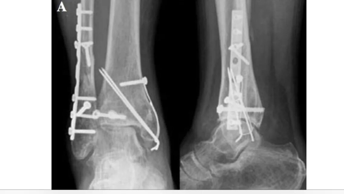 После артродеза голеностопного сустава. Перелом лодыжки с остеосинтезом. Операция артродез голеностопного сустава.