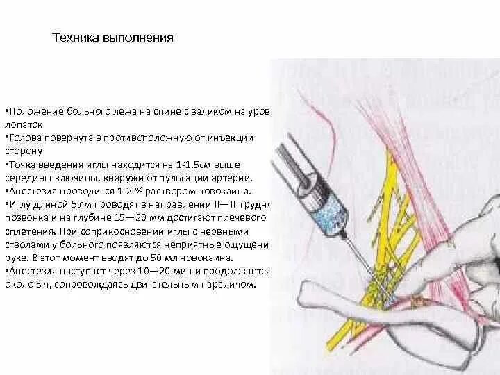 Блокада техника выполнения. Блокада пудентального нерва. Срамной нерв анатомия. Проводниковая новокаиновая блокада.