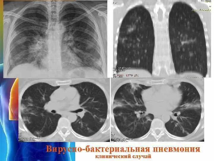 Поражение легких при ковиде. Бронхопневмония пневмония на кт. Вирусная пневмония на кт легких. Пневмония на снимке кт легких. Вирусная пневмония ковид кт.