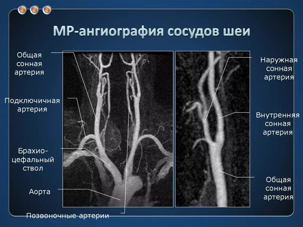 Магнитно-резонансная ангиография сосудов головного мозга. Протокол кт-ангиографии сосудов мозга. Магнитно-резонансная ангиография сосудов шеи. Мрт ангиография сосудов головного мозга анатомия.