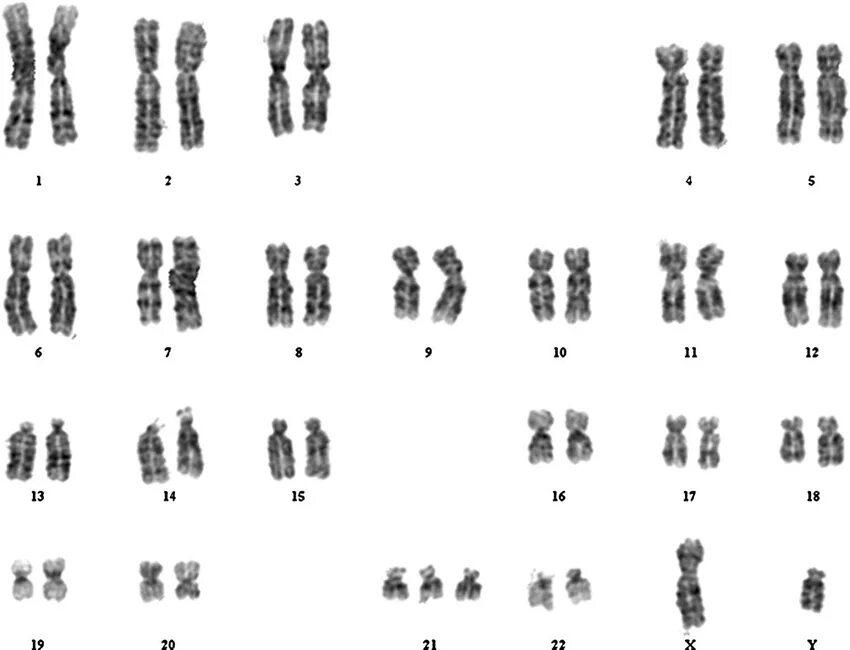 Пересадка хромосом. Синдром Дауна кариотип. Синдром Дауна 21 хромосома. Хромосомная патология трисомия хромосомы 16. Синдром Дауна трисомия 21 хромосомы.