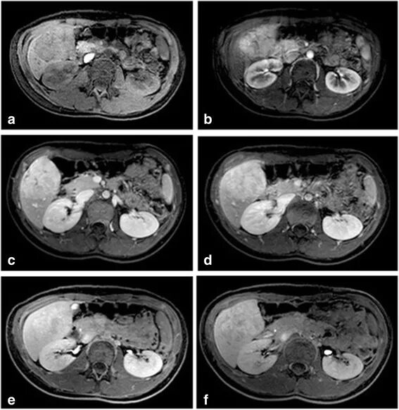 Подготовка к мрт печени. Focal nodular hyperplasia of the liver mri. гипоинтенсивные метастазы печени мрт.