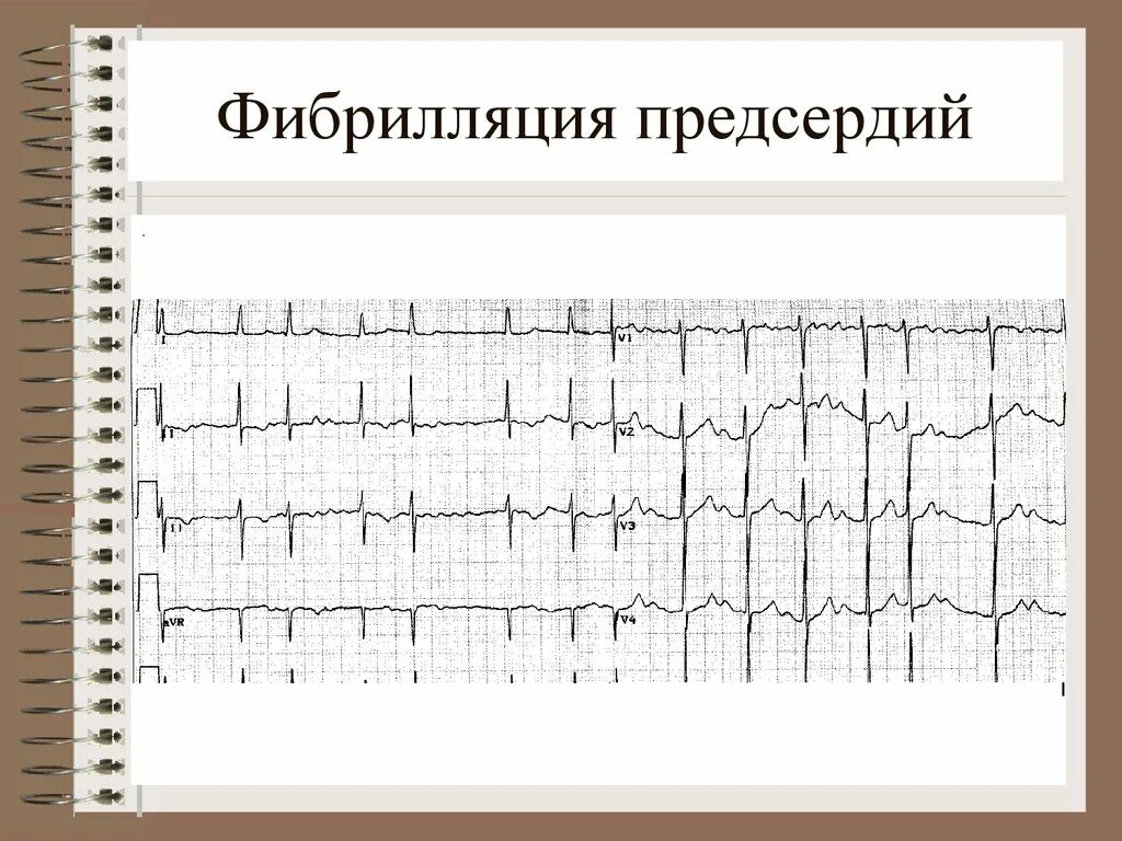 Фибрилляция предсердий ЭКГ тахисистолия. Пароксизмальная форма фибрилляции предсердий ЭКГ. Пароксизмальная фибрилляция предсердий на ЭКГ. ЭКГ при фибрилляции предсердий. Формы трепетания предсердий