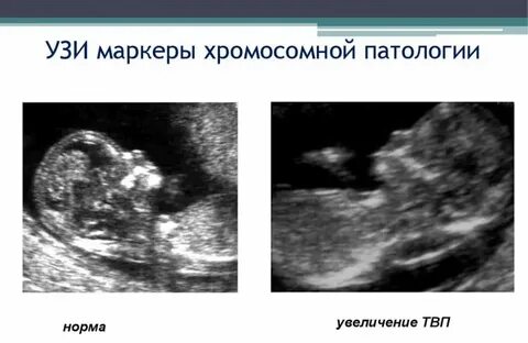 Синдром эмбрион