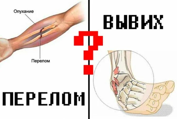 Чем отличается вывих от растяжения. Отличие перелома от ушиба. Чем отличается вывих от растяжения. Как отличить вывих от перелома. Припухлость при растяжении связок голеностопа.
