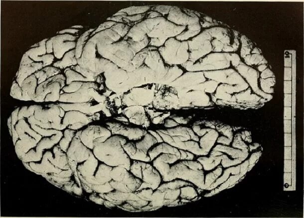 Очаги сосудистого генеза головного мозга что это. Глиоз мозга. Вазогенные очаги. Очаги сосудистого генеза в головном мозге. Глиозные очаги головного мозга на кт.