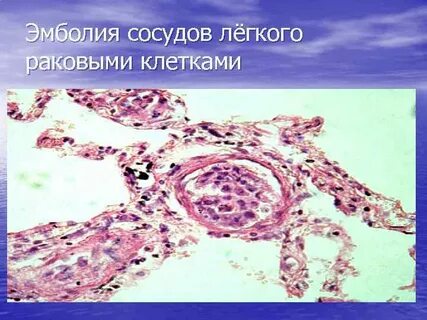 Сосудистые легкие
