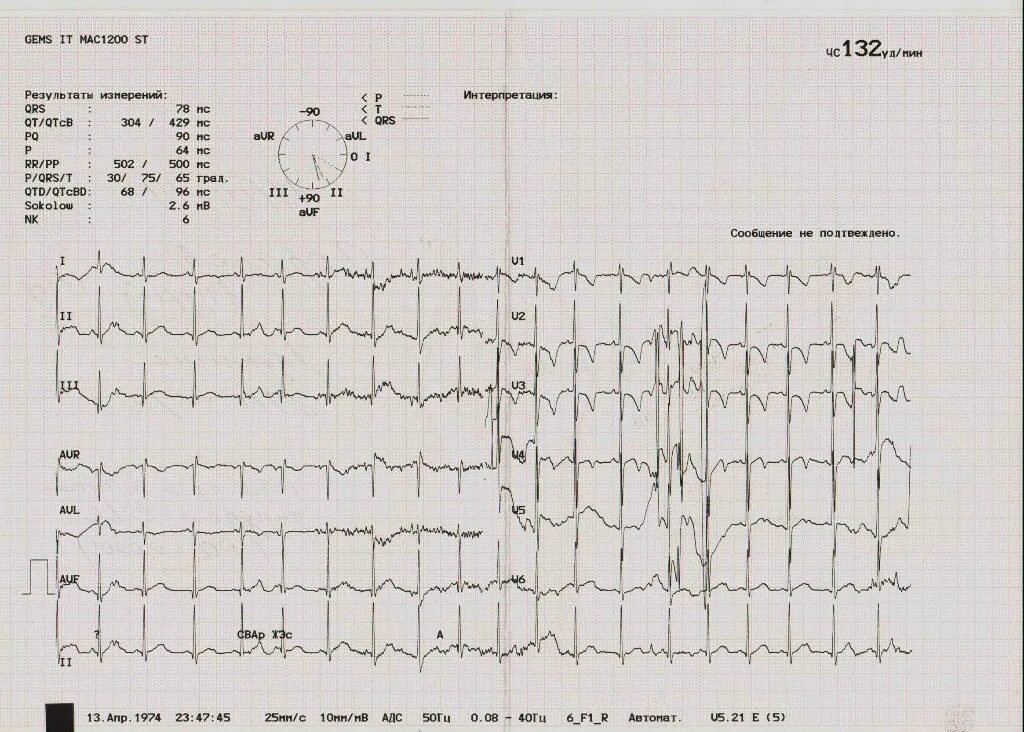 Экг ребенку 7 лет. QRS норма ЭКГ У ребенка 10 лет. PQ норма ЭКГ У ребенка 10 лет. ЭКГ норма у детей до 3 лет. ЭКГ ребенка 3 лет норма.