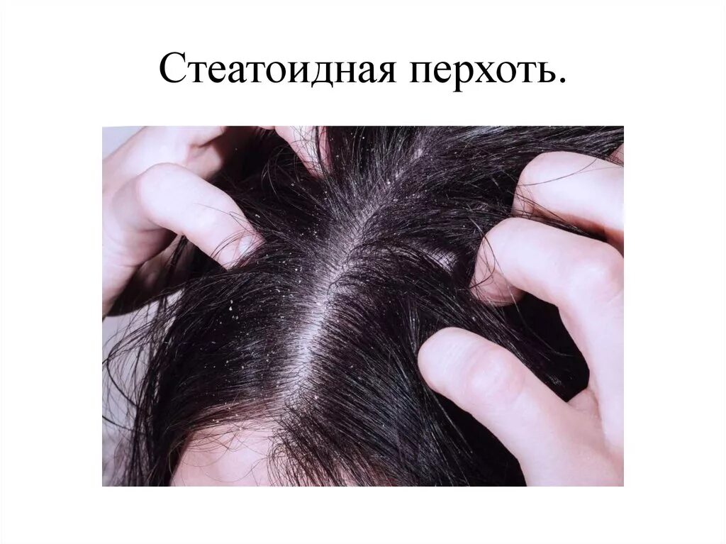 Фолликулит волосистой части головы. Гнейс на волосистой части головы. Появление на волосистой части головы ггнйса.