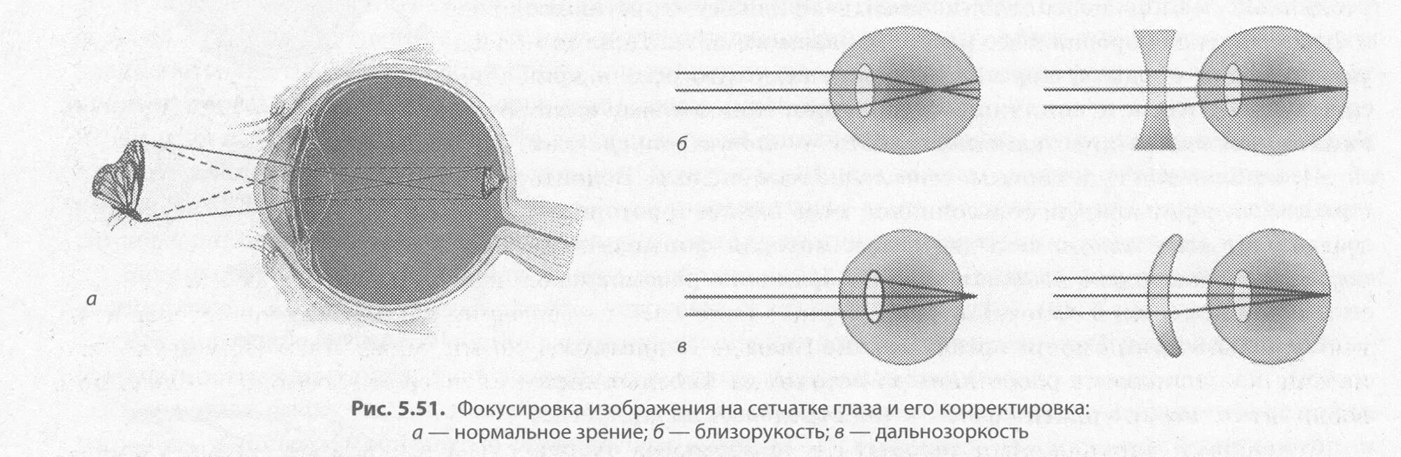 Фокусировка глаза человека. Фокусировка изображения на сетчатке. Изображение фокусируется на сетчатке. Фокусировка света на сетчатке. Строение глаза при близорукости и дальнозоркости.