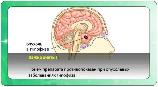 Симптомы гипофиз у мужчин. Новообразования в гипофизе. Опухоли передней доли гипофиза.