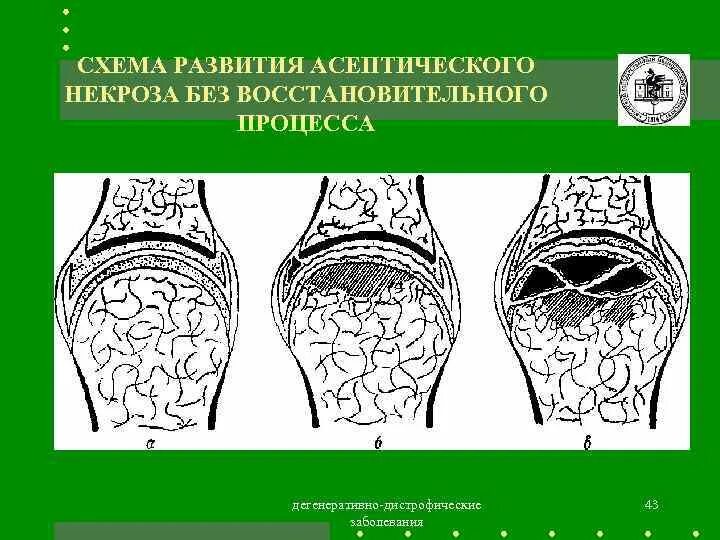 Асептический некроз без операции. Остеоперфорация асептический некроз. Дегенеративно – дистрофические поражения и асептические некрозы. Рентген асептический некроз бедренной кости. Асептический некроз стадии рентген.