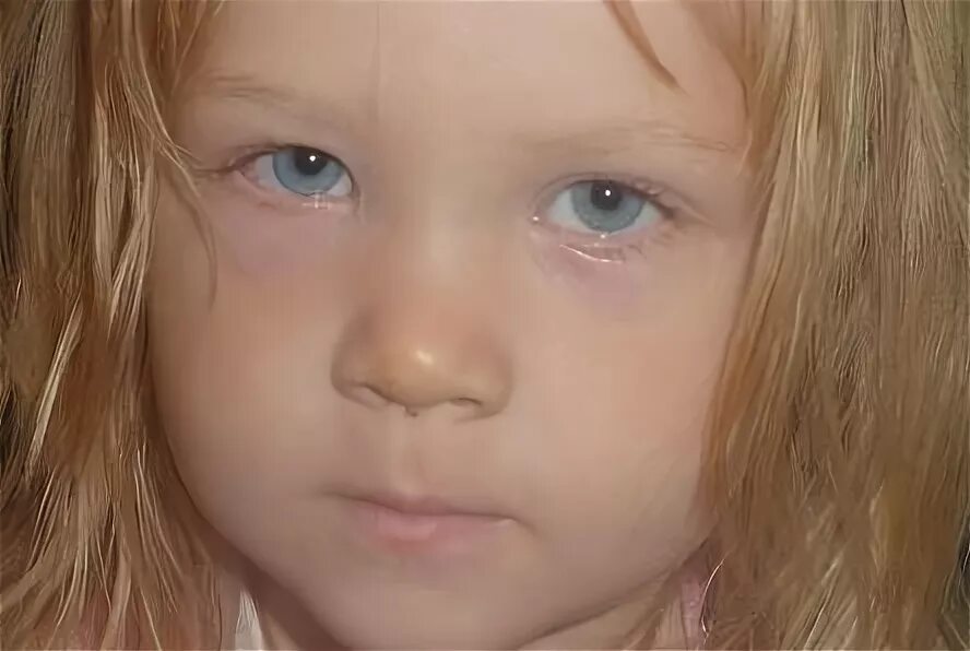 Ребенок 3 года бледный. Бледность у детей. Припухлость под глазами у ребенка. Бледность кожи у ребенка.