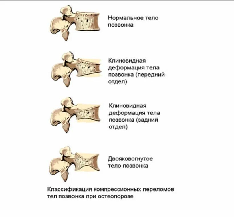 Компрессионный перелом тела l3 позвонка. Степени компрессии перелома позвонков. Клиновидная деформация позвонков классификация. Компрессионный перелом позвоночника т11. Компрессионный перелом тела 1 1