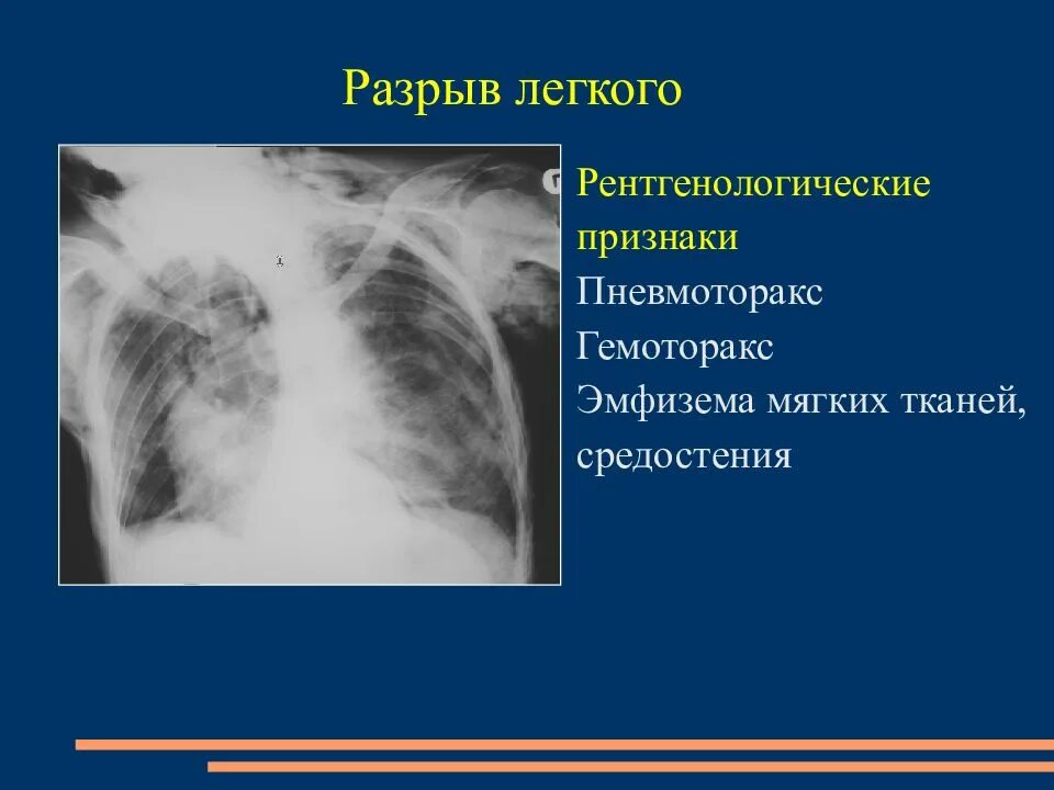 Разрыв легкого рентген. Симптомы порванного легкого.