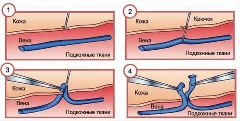 Удаление большой подкожной