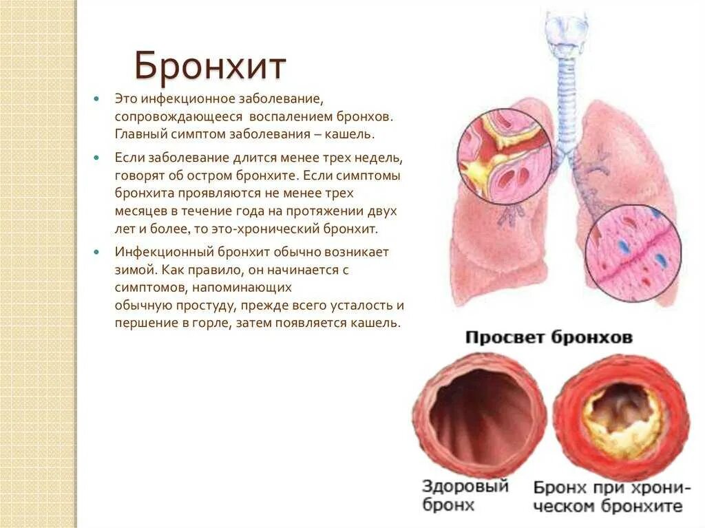 Хронический легкий кашель. Детские заболевания бронхит. Поражение бронхов острый бронхит. Бронхит сообщение по биологии. Причина бронхита 8 класс биология.