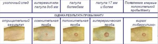 После 02. Реакция манту норма у детей 5 лет. Реакция манту норма у детей 7 лет. Реакция манту норма у детей 3 года норма таблица. Реакция манту норма у детей 1.5 года.