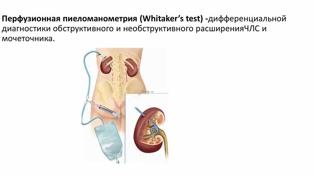 Необструктивный хронический пиелонефрит с рефлюксом. Обструктивные уропатии патогенез. Необструктивные заболевания почек. Обструктивная уронефропатия.