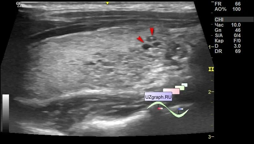 Уз признаки диффузных изменений щитовидной. Аденома щитовидной железы на УЗИ. Диффузные изменения щитовидной железы УЗИ. Аденома паращитовидной железы на УЗИ. Паращитовидная железа на УЗИ картинки.