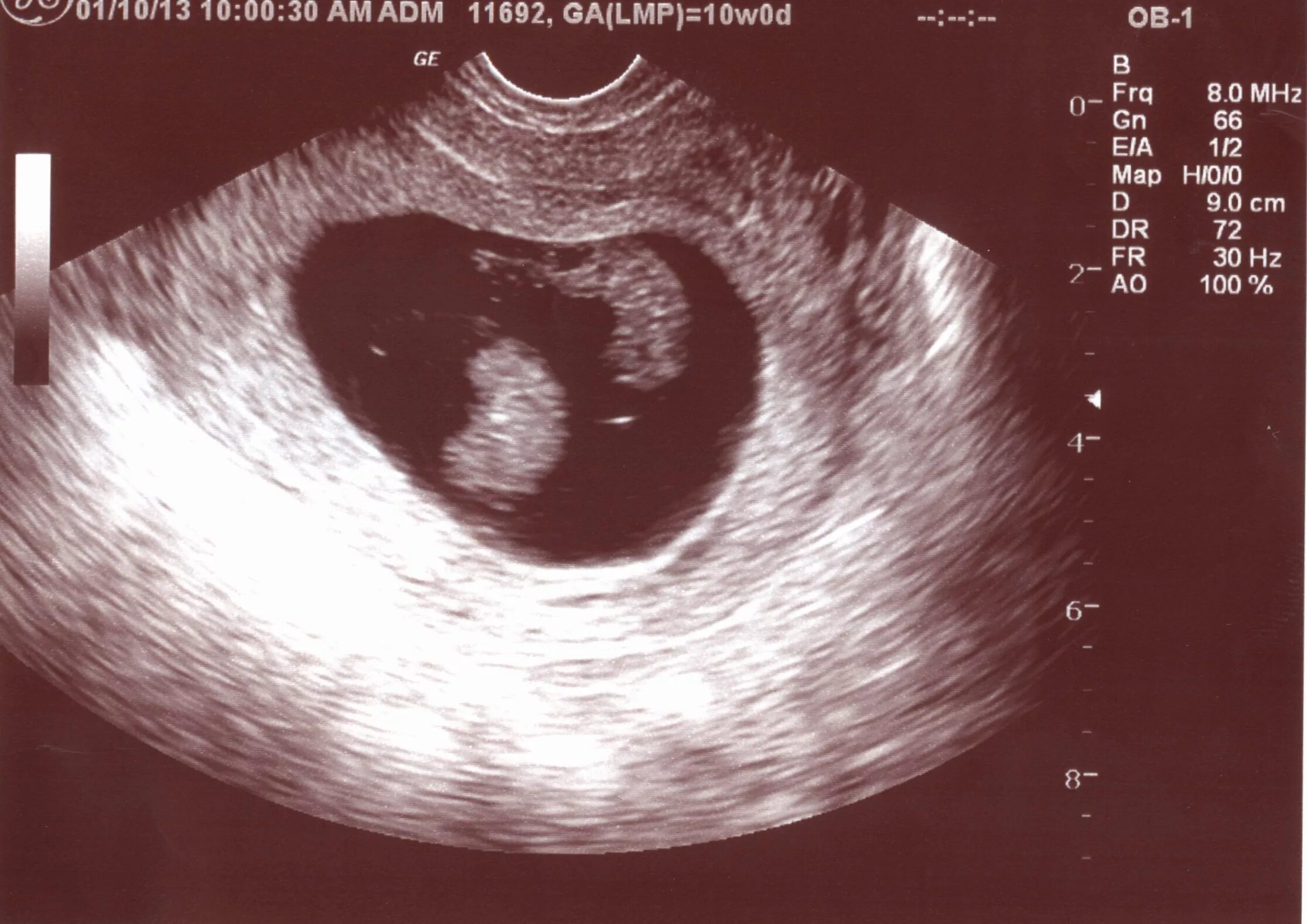 Как выглядит узи на 6 неделе. УЗИ беременность 6 недель однояйцевые Близнецы. УЗИ многоплодной беременности на 6 неделе беременности. УЗИ близнецов на 5 неделе беременности. УЗИ 6 недель беременности двойня.