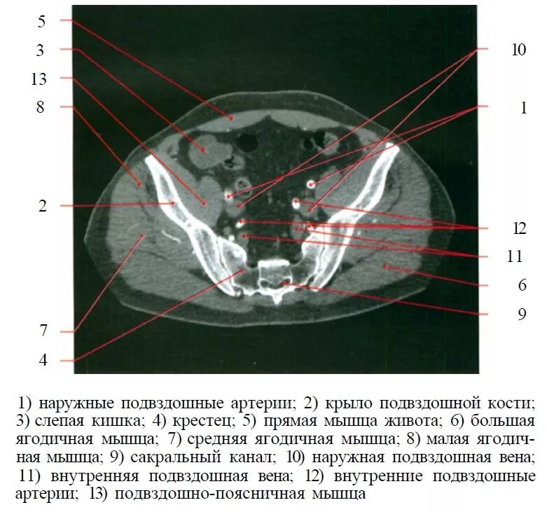 Кт подвздошной кости. Мышцы таза кт анатомия. Подвздошная кость анатомия кт. Мышцы малого таза кт анатомия. Кт анатомия брюшной полости.