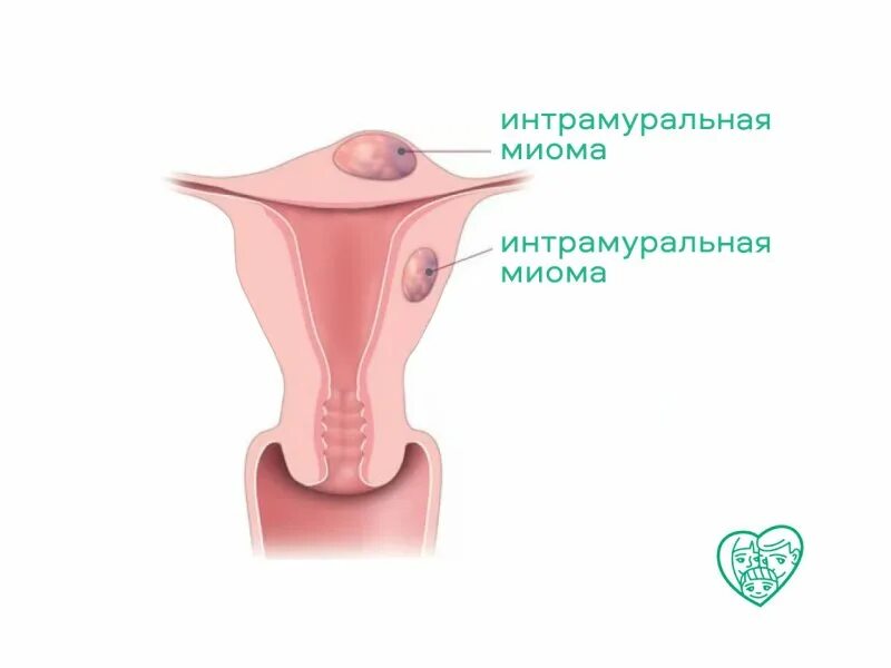 Формы миомы матки. Интрамуральная миома матки что это такое. Интрамуральный субсерозный узел. Интрамуральная субсерозная миома. Интрамуральная миома гинекология.