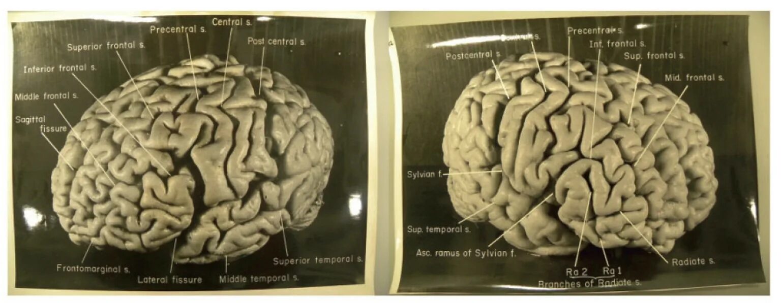 1 масса головного мозга. Мозг Эйнштейна. Мозг гения и мозг обычного. Головной мозг Эйнштейна.
