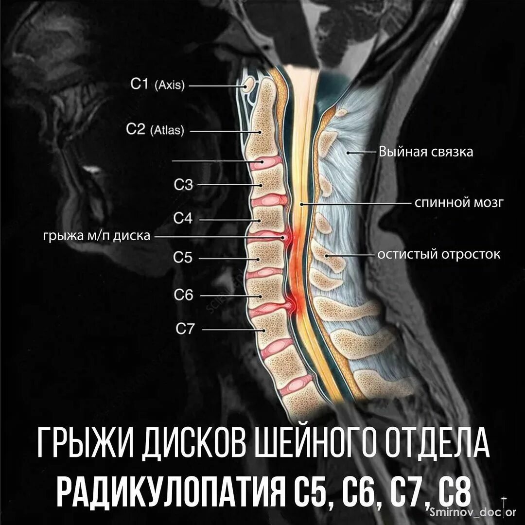 Междисковые грыжи шейного отдела. Грыжа межпозвоночного диска шейного отдела. Вентральная грыжа позвоночника. Грыжа диска шейного отдела позвоночника мрт. Грыжи в шейном отделе позвоночника последствия.