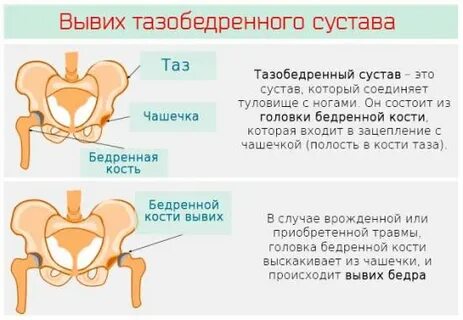 Симптомы вывиха тазобедренного сустава